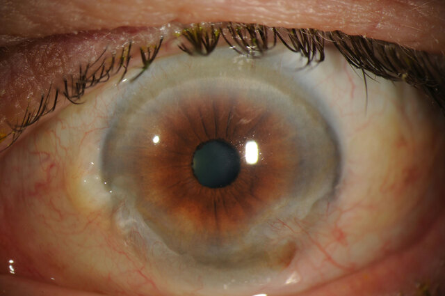 درمان نابینایی با پیوند سلول‌های بنیادی چشم افراد متوفی