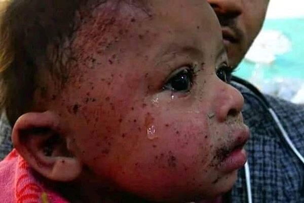 «حلیمه»؛ نوزادی که حملات متجاوزان سعودی باعث شد طعم تلخ بی‌مادری را تجربه کند + تصاویر