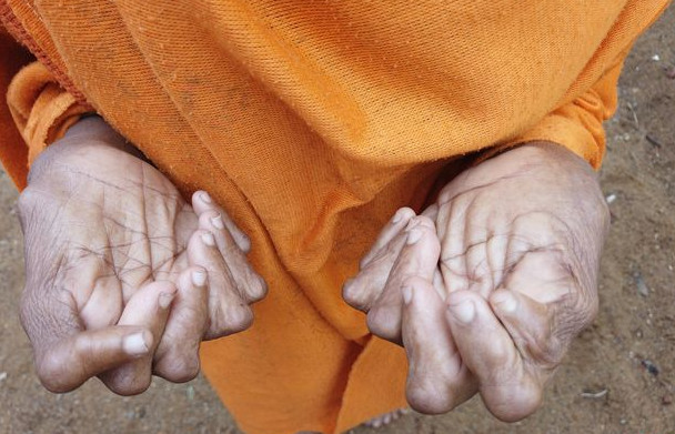 زنی که بیشترین انگشت دست و پا را در اختیار دارد! +تصاویر