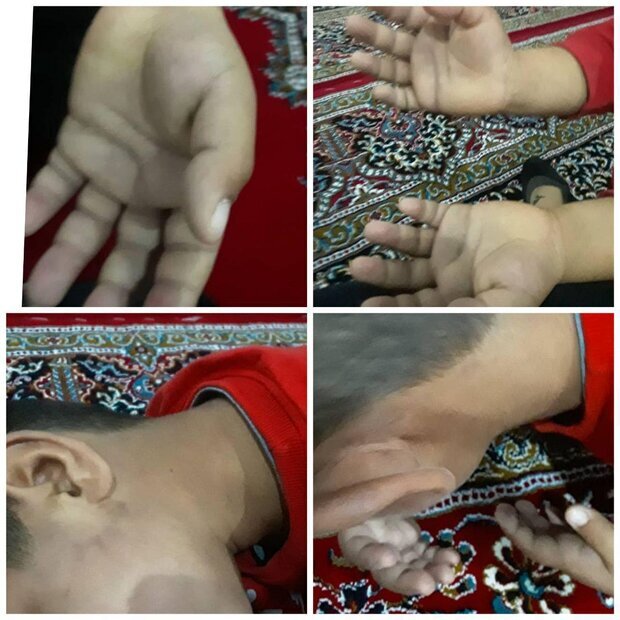 تنبیه سنگین دانش آموز ایلامی + ۵ عکس دلخراش تنبیه سنگین دانش آموز ایلامی + ۵ عکس دلخراش